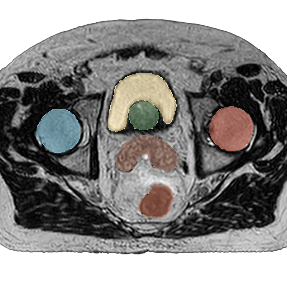 Prostate Segmentation Example